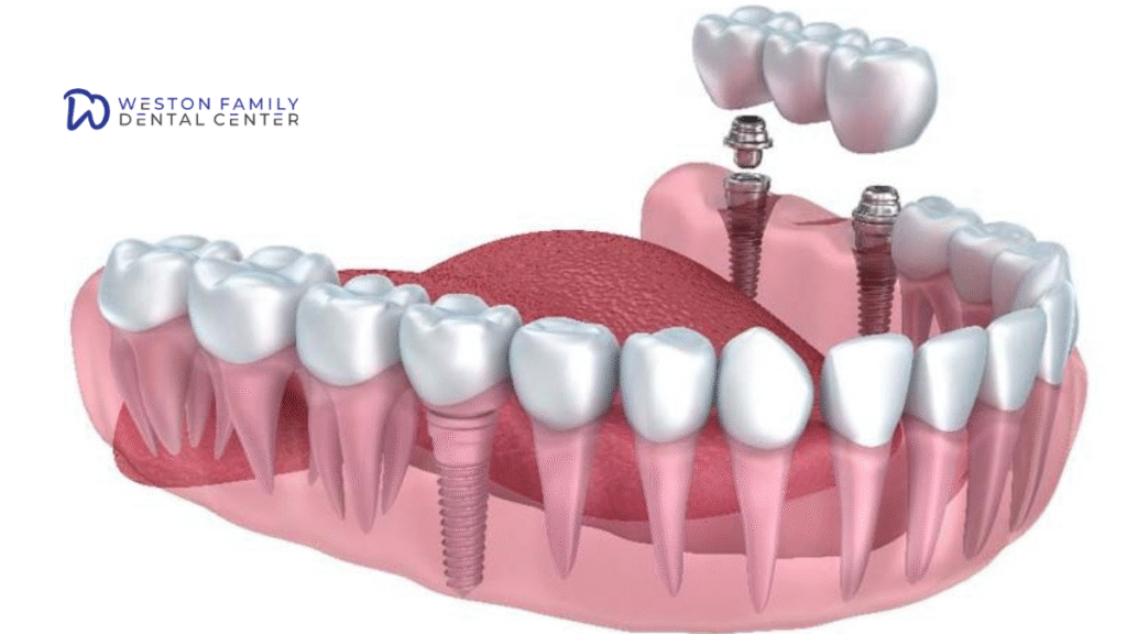 Dental Implants in Weston