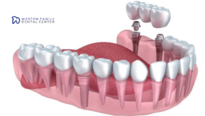 Dental Implants in Weston