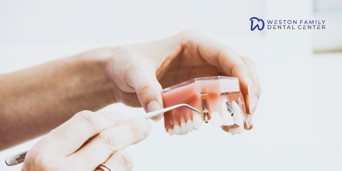 Bone Graft Before Dental Implants Do You Really Need One