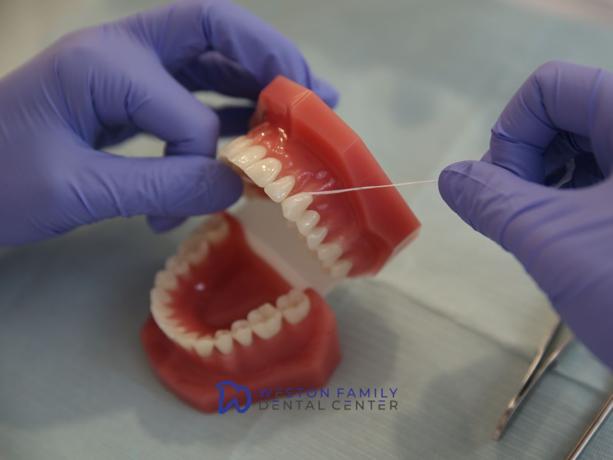 How Long Do Full-Arch Dental Implants Last A Guide for Weston Patients