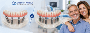 All-on-4 vs full-arch dental implants showing implant-supported full-arch restorations